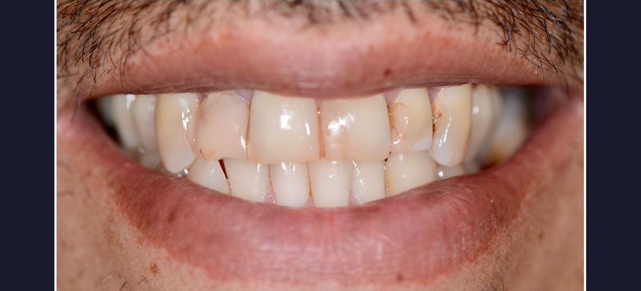 Full arch whitening before