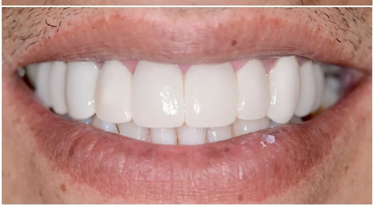 Jason after treatment — full arch restored with porcelain crowns