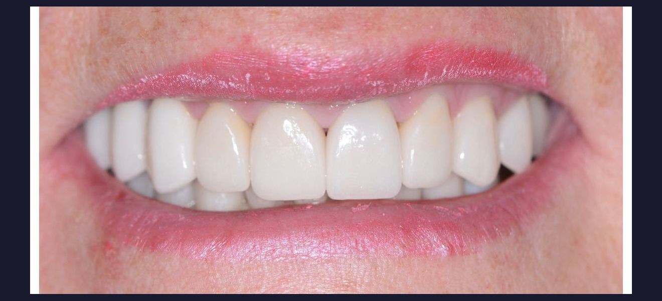 Crowding correction after veneers