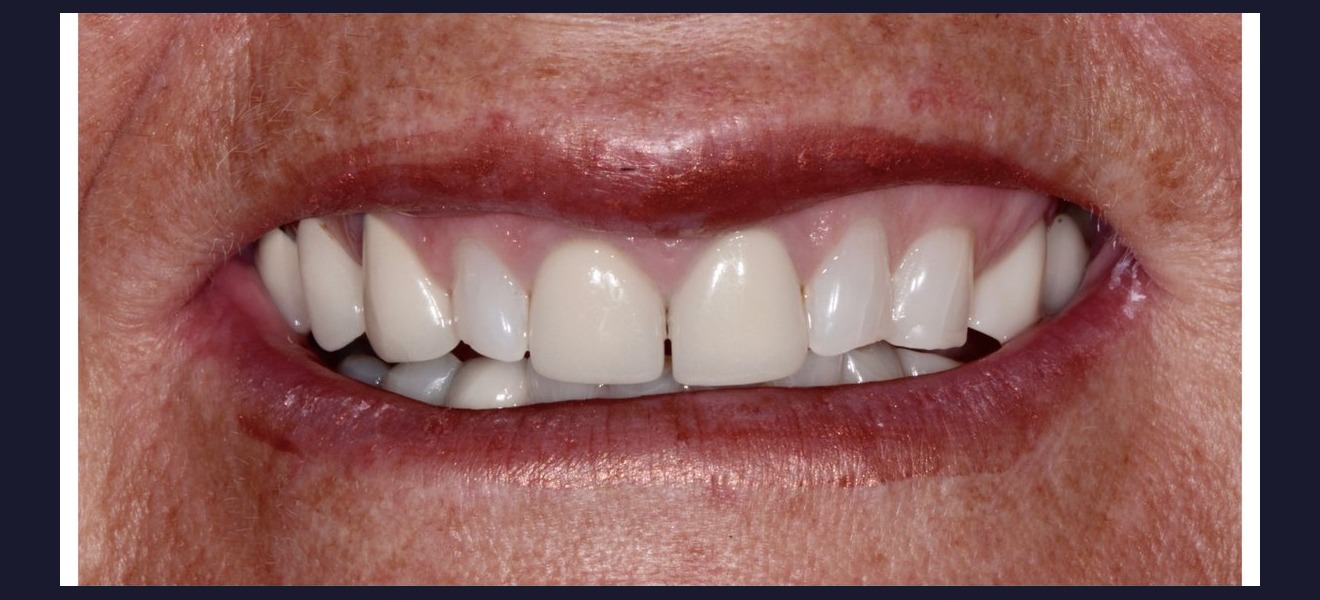 Crowding correction before veneers
