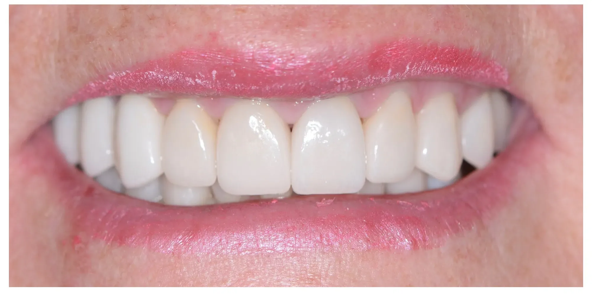 After veneers — Joanne — Full-Mouth Transformation