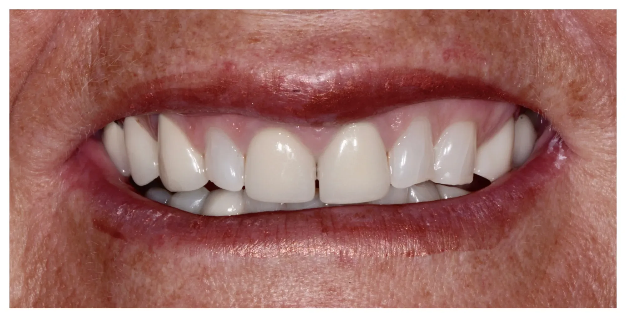Before veneers — Joanne — Full-Mouth Transformation