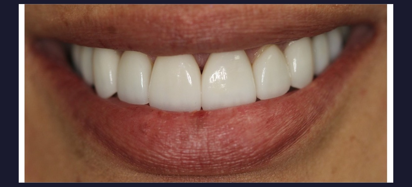 Smile brightening and shape correction after veneers