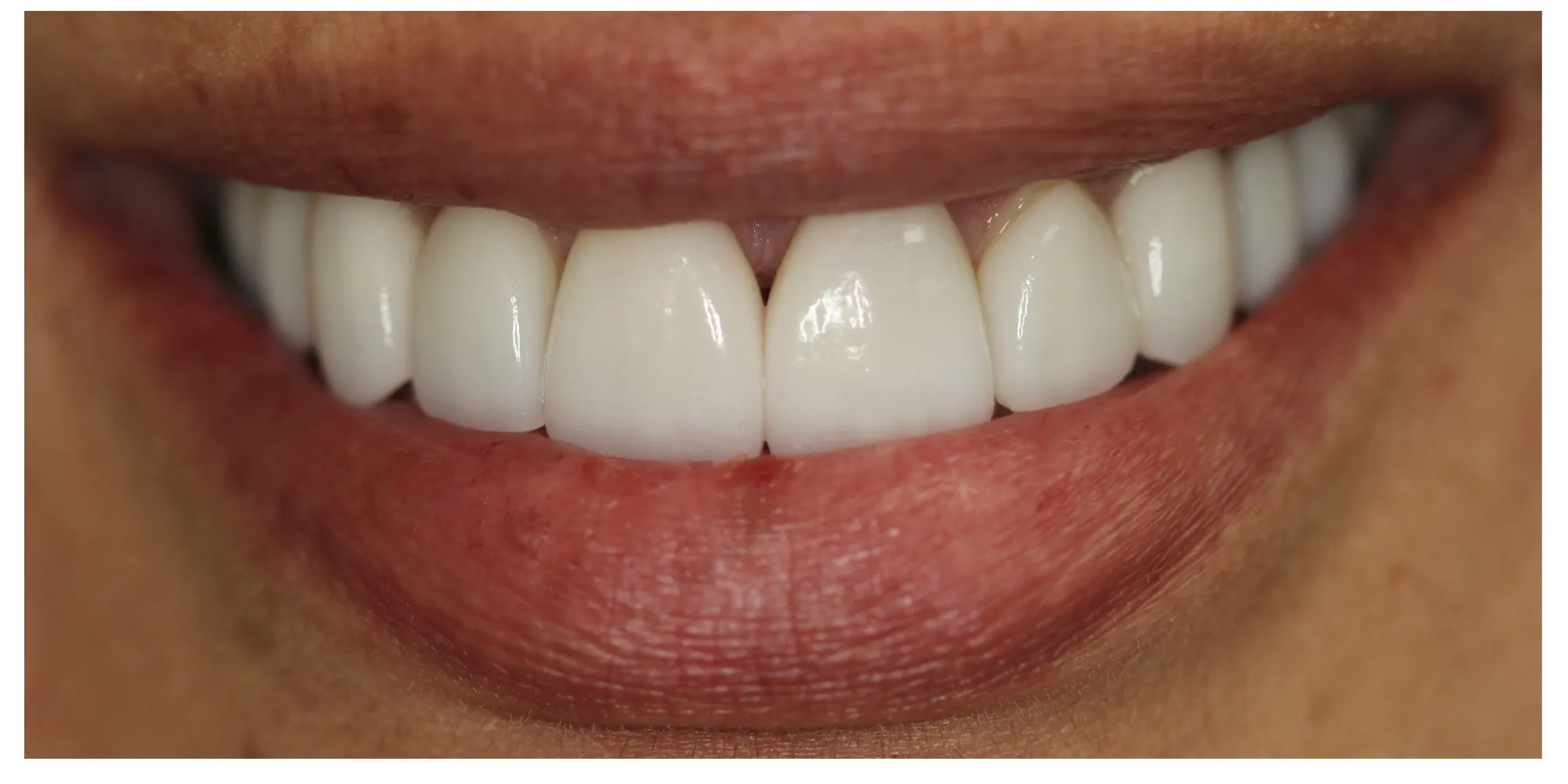 Mary's bright, natural-looking smile after porcelain veneers