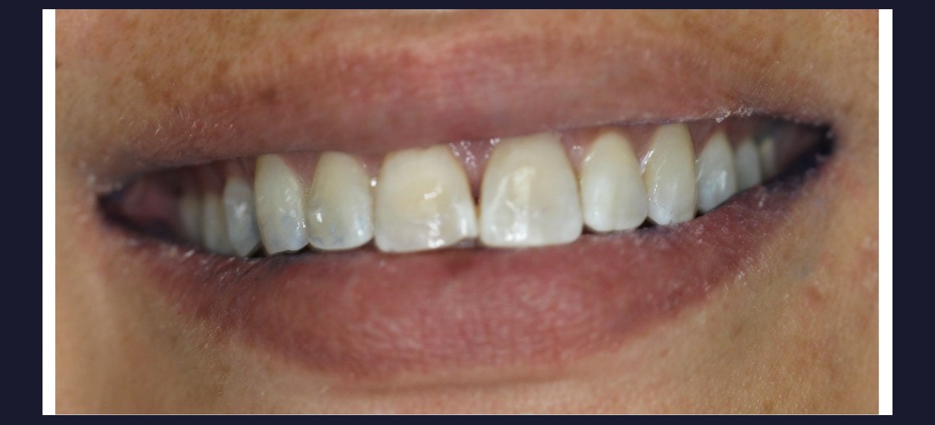 Smile brightening and shape correction before veneers