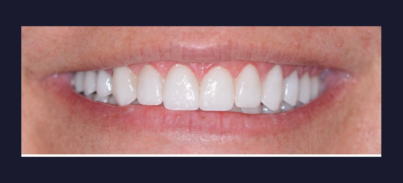 Smile refinement after veneers