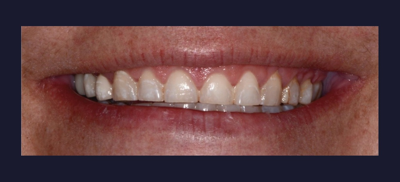 Smile refinement before veneers