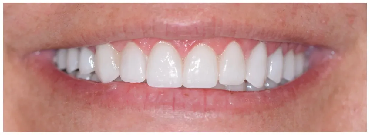 Nikki after treatment — full arch restored with rebuilt vertical dimension