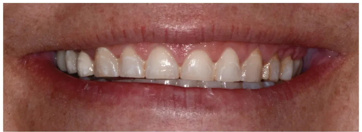 Nikki before treatment — severe wear and vertical dimension loss from bruxism