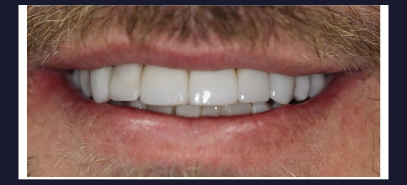 Full arch restoration after