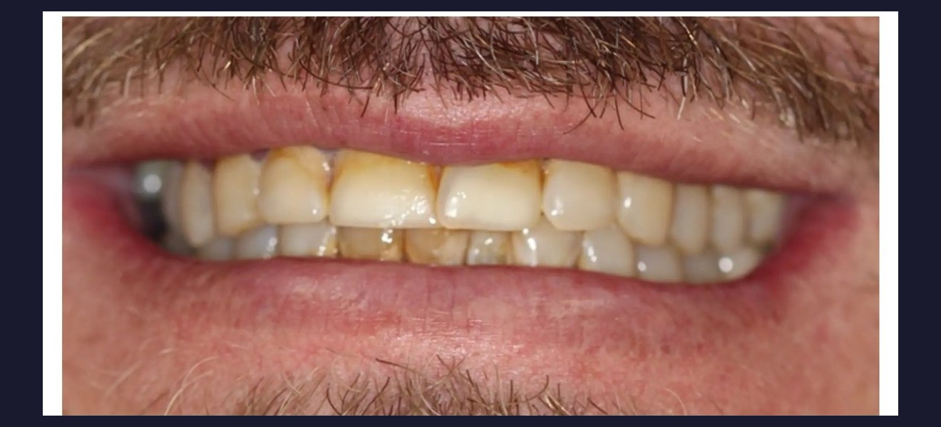 Full arch restoration before