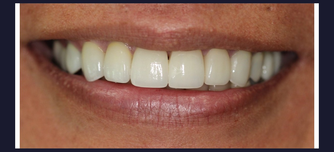 Complete smile transformation after veneers