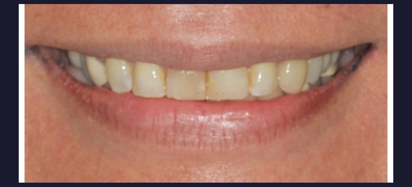Complete smile transformation before veneers