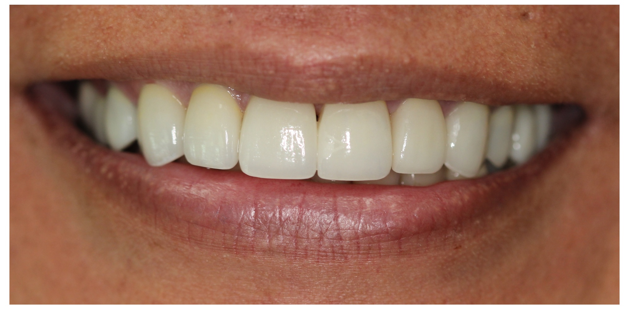 Complete smile transformation after veneers