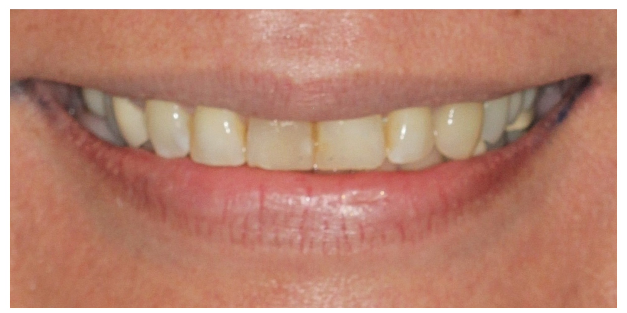 Complete smile transformation before veneers