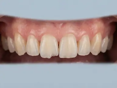 Front tooth with a chipped edge