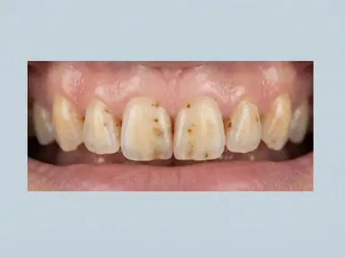Teeth with visible surface staining