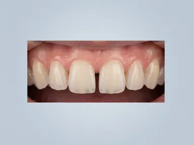 Front teeth with a visible gap