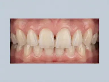 Front teeth with minor misalignment