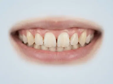 Balanced smile illustrating an overall makeover goal