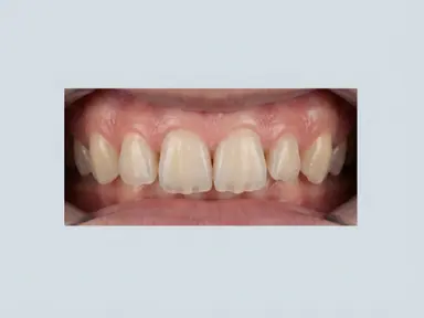 Front teeth with uneven shapes and sizes