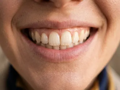 Close view of a few upper front teeth