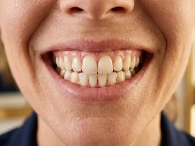 Natural smile showing upper and lower teeth