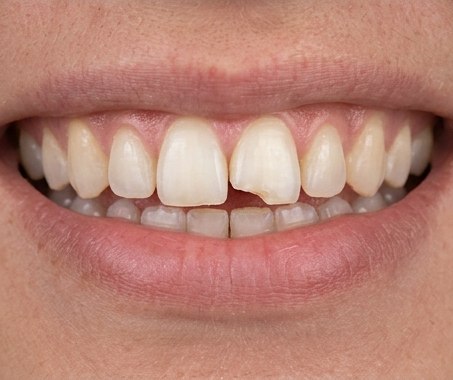 Close-up example of a chipped front tooth