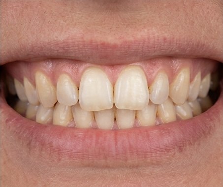 Close-up example of mildly crooked front teeth