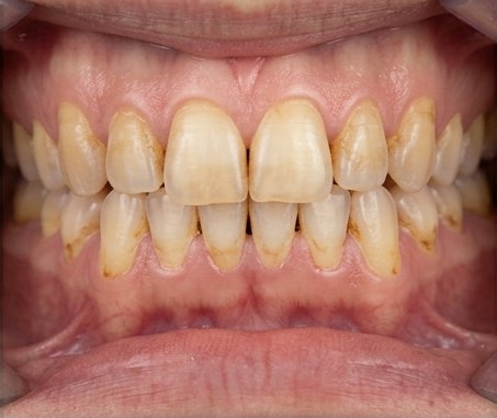 Close-up example of tooth discoloration