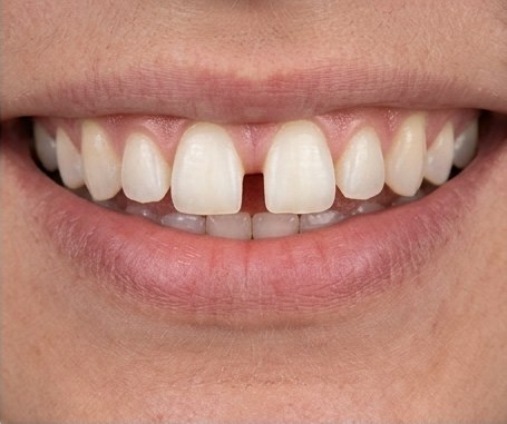 Close-up example of spacing between front teeth