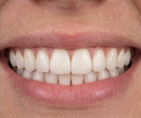 Close-up example of a polished full smile makeover
