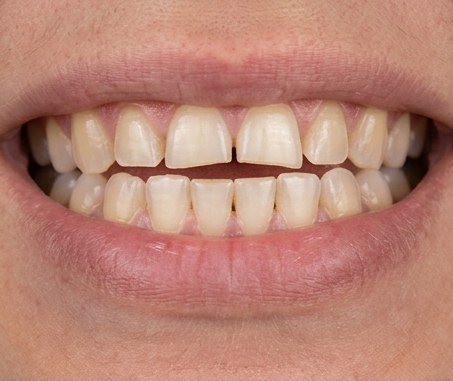 Close-up example of worn front teeth